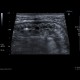 Crohn's disease, acute inflammation, ascites: US - Ultrasound